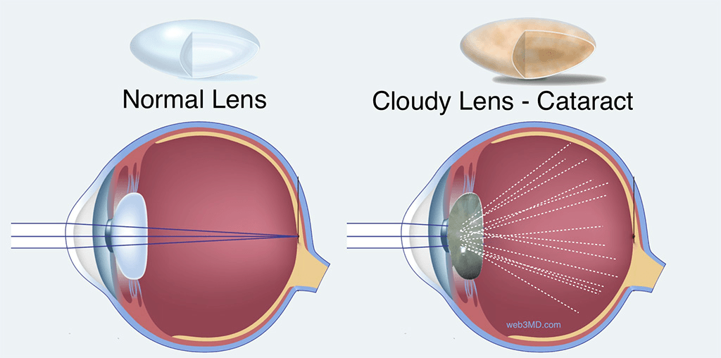 What is a Cataract โ eye lens diagram